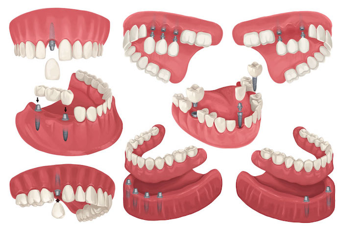 a variety of dental implant configurations to replace missing teeth