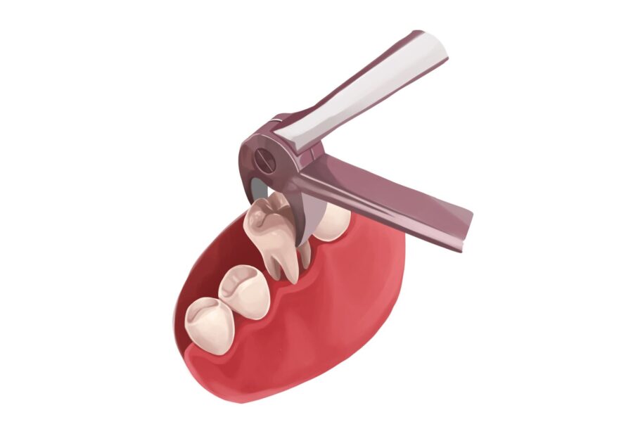 Closeup illustration of a dental tool performing a tooth extraction against a blank white background