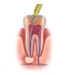 Illustration of a tooth undergoing root canal therapy to remove a damaged pulp and infection