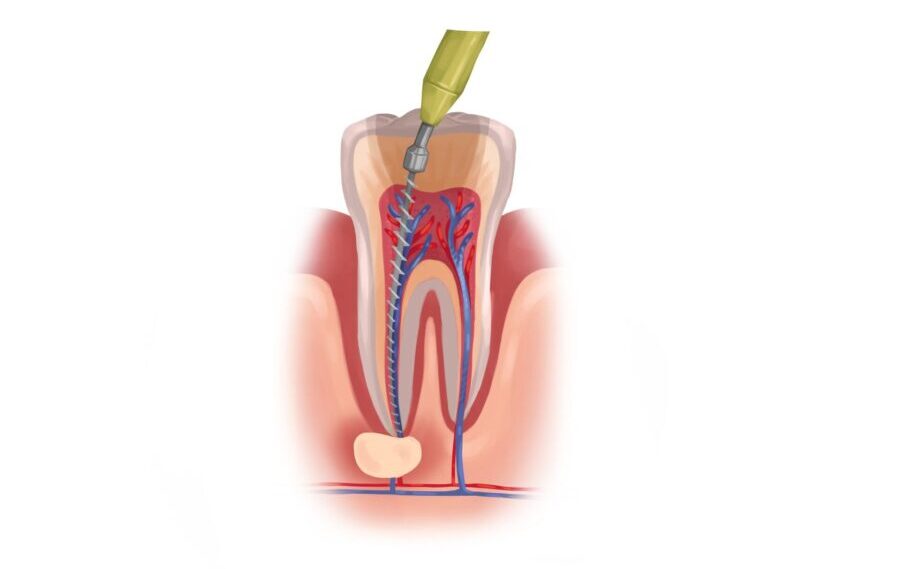 Illustration of a tooth undergoing root canal therapy to remove a damaged pulp and infection