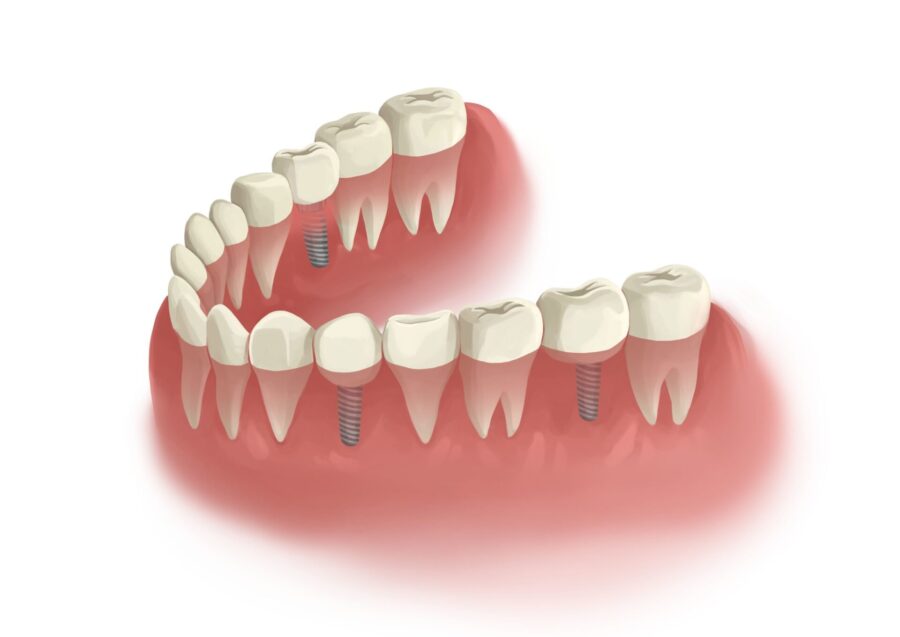 Illustration of dental implants to permanently replace missing teeth