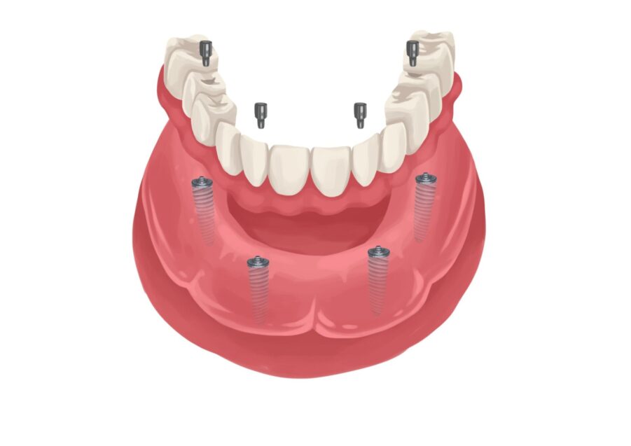 Technical graphic illustration of an implant supported denture.