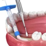 dental bone graft