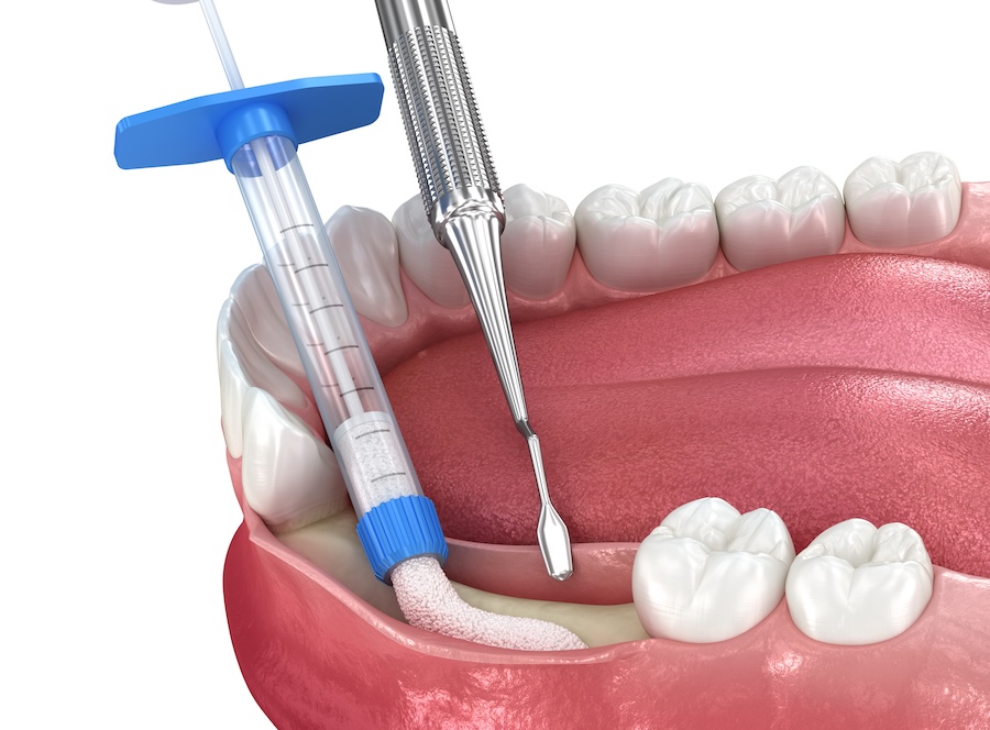 dental bone graft