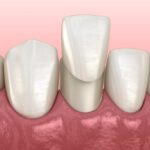 dental veneers