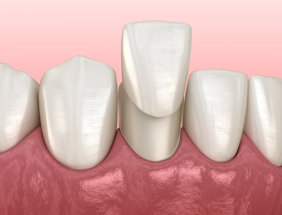 dental veneers