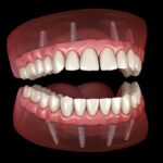how to care for implant supported dentures
