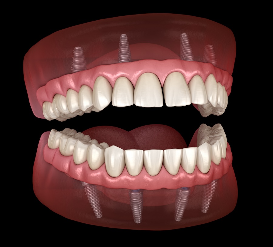 how to care for implant supported dentures