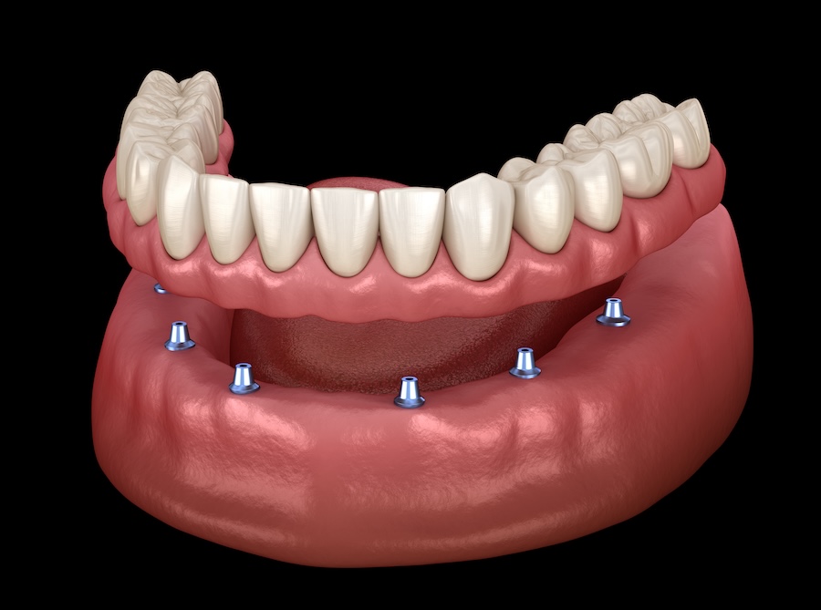 implant supported dentures, implant retained dentures