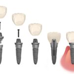 dental implant parts, loose dental implant
