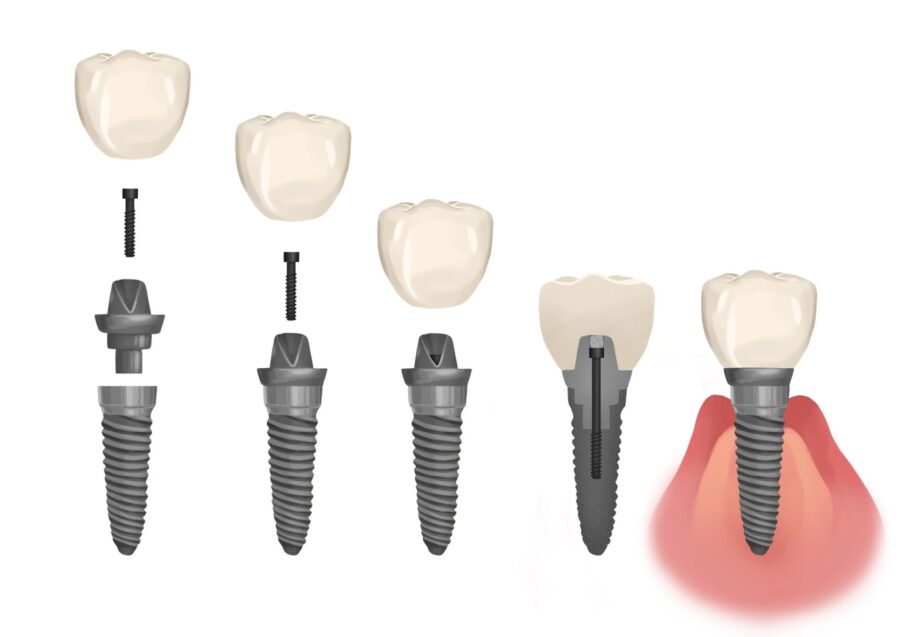 dental implant parts, loose dental implant