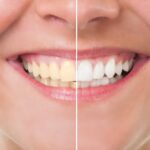 teeth whitening and enamel