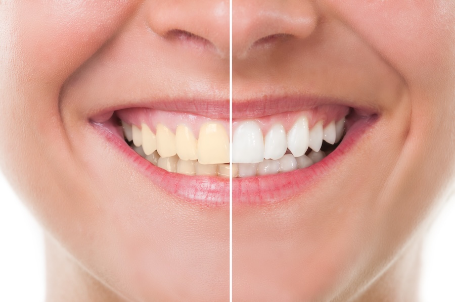 teeth whitening and enamel